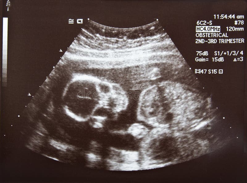 Fetal ultrasound dating