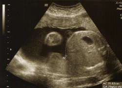 fetal dating scan