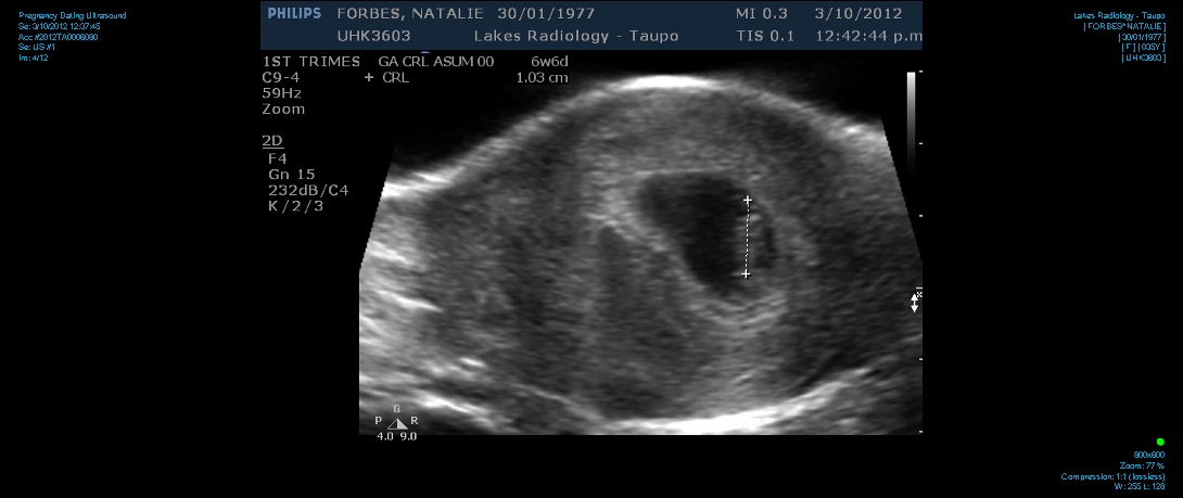 Pregnancy ultrasound dating